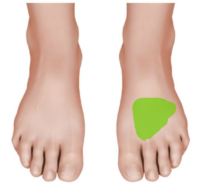 Foot pain heel outside edge, heel comfort insoles, metatarsal pain and