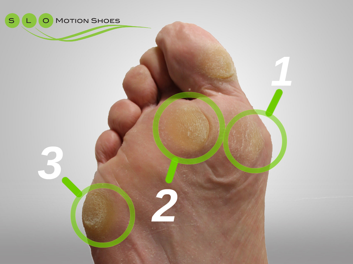 The Anatomy Of A Callus SLO Motion Shoes