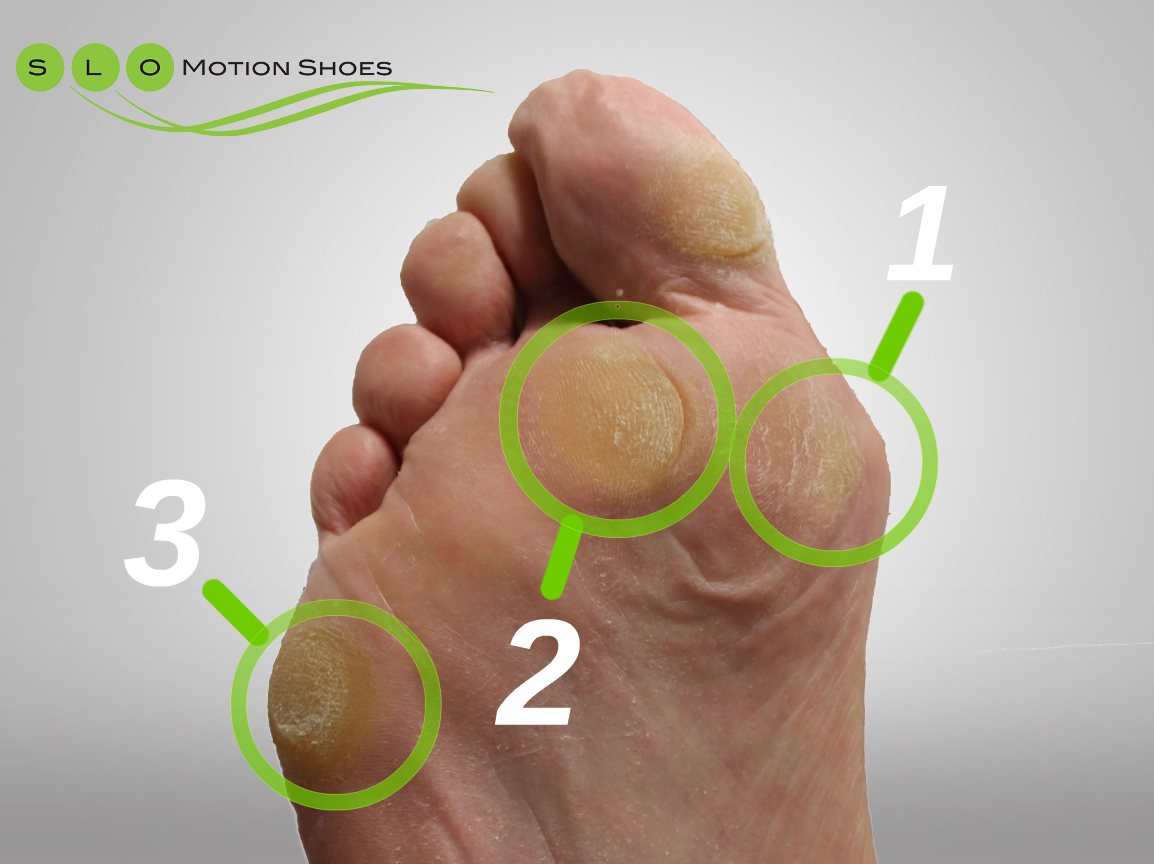 The Anatomy of a Callus - SLO Motion ShoesSLO Motion Shoes