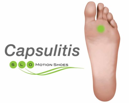 Capsulitis