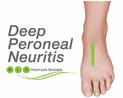 Deep-Peroneal-Neuritis