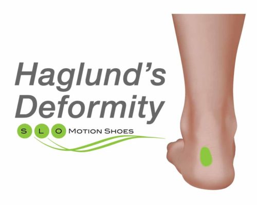 Haglund's-Deformity