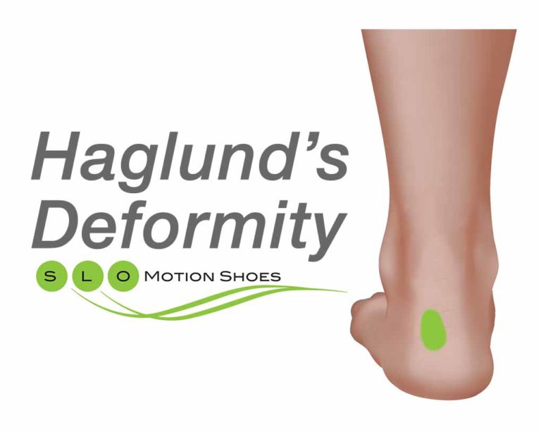 Haglund'sDeformity SLO Motion ShoesSLO Motion Shoes