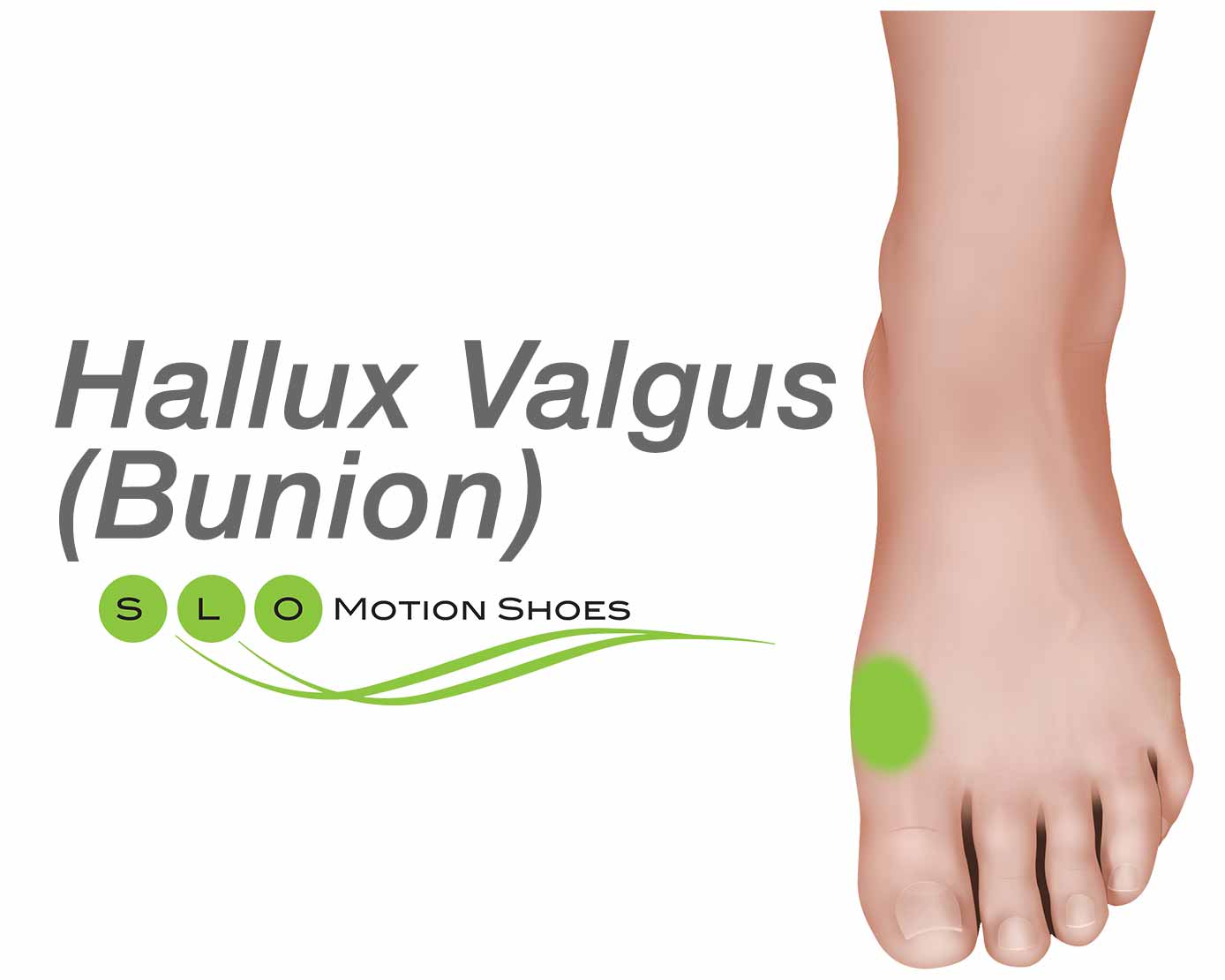 Халлюкс вальгус. Hallux valgus Рентгенометрия. Hallux valgus лечение v образный.