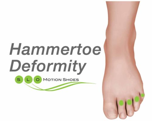 Hammertoe-Deformity