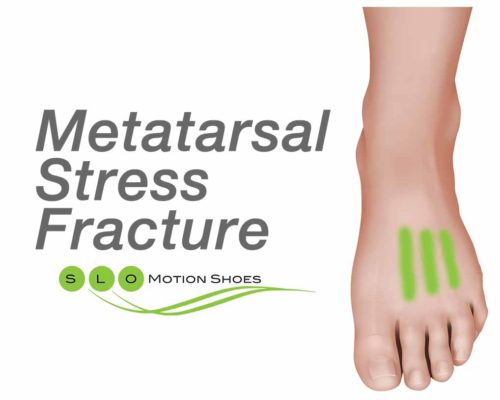Metatarsal-Stress-Fracture