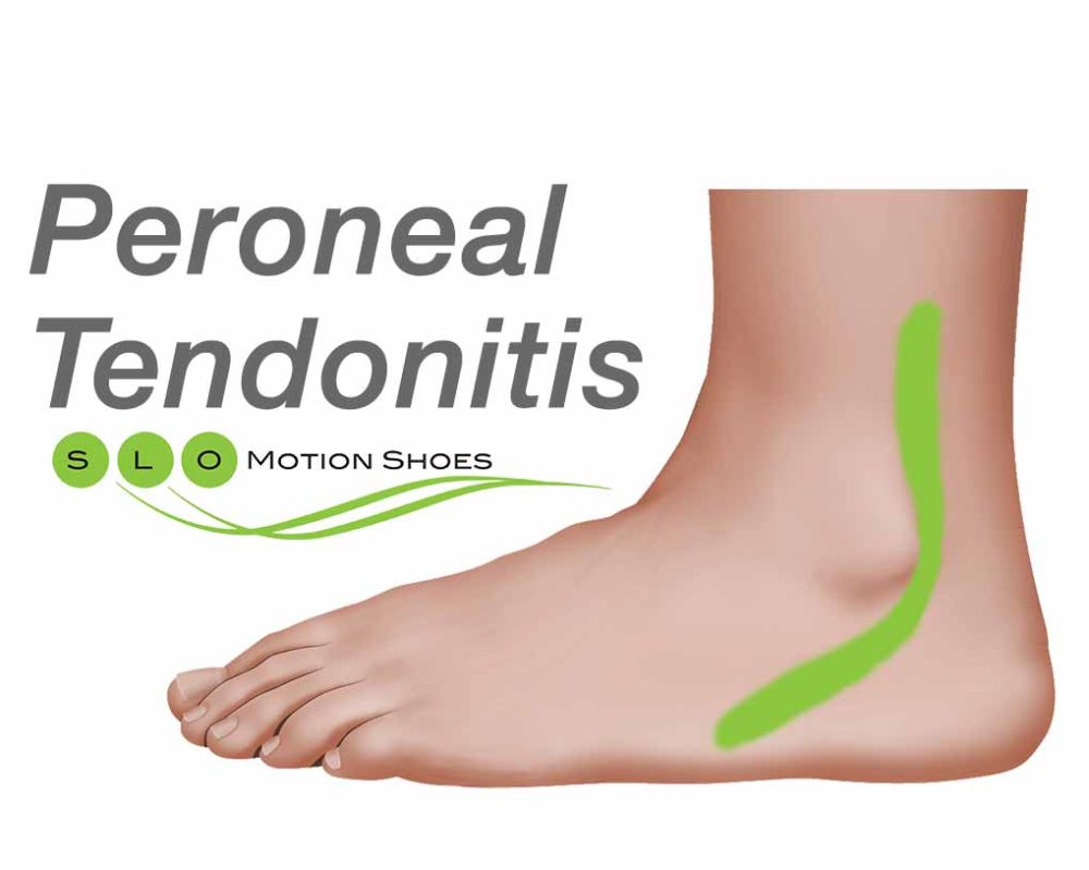 Peroneal-Tendonitis - SLO Motion ShoesSLO Motion Shoes