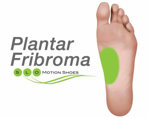 Plantar-Fibroma