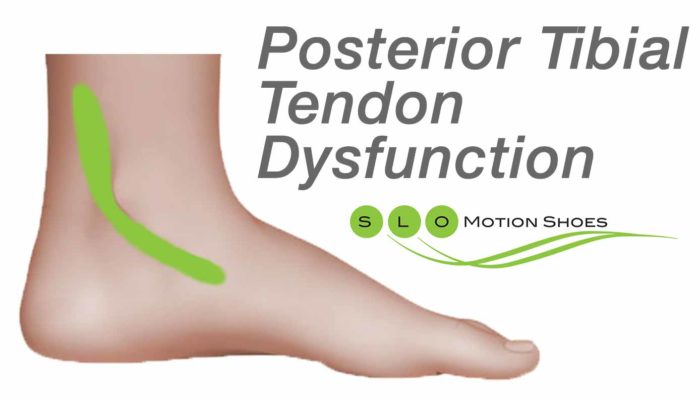 Posterior-Tibial-Tendon-Dysfunction(2)
