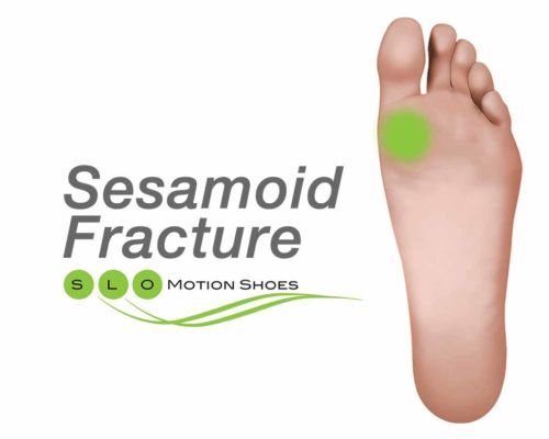 Sesamoid-Fracture