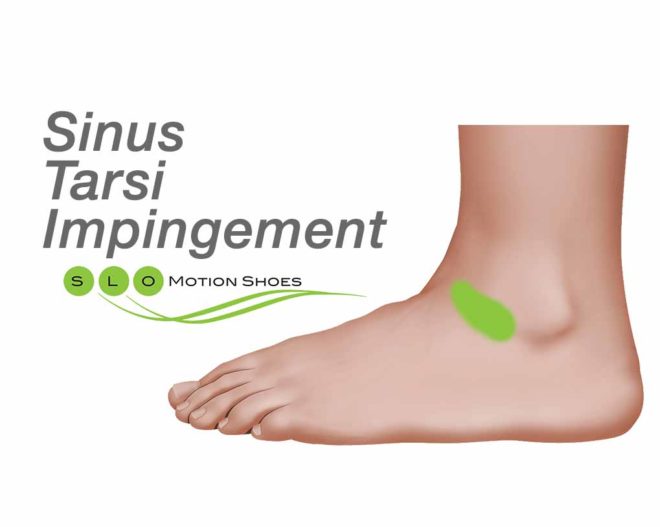 Sinus-Tarsi-Impigment - SLO Motion ShoesSLO Motion Shoes