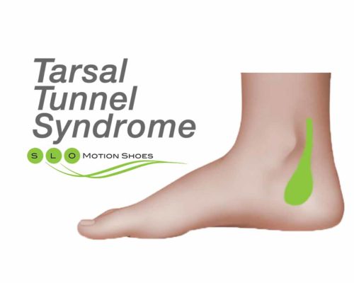 Tarsal-Tunnel-Syndrome