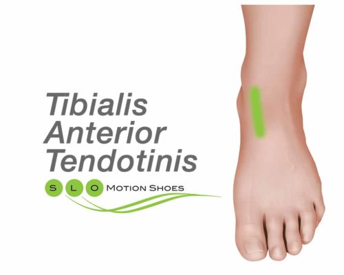Tibialis-Anterior-Tendonitis